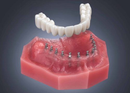 Alternativas de Dentadura en Wiles-Barre, PA | Mini Implantes Dentales