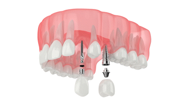 Mini Dental Implant | Mint Mini Dental Implants in Wilkes-Barre, PA