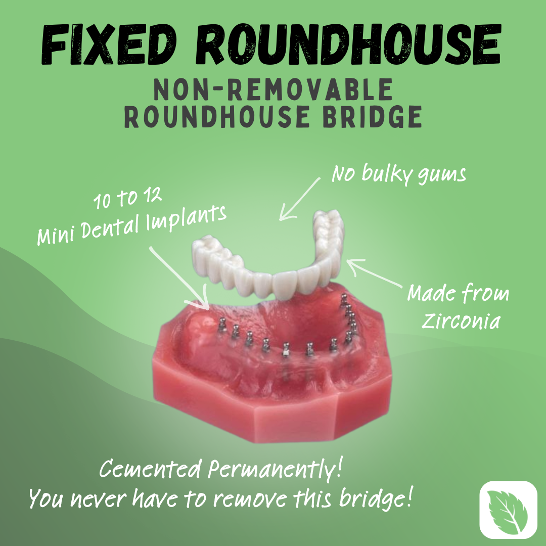 Fixed Roundhouse Full Arch Implant Denture in Pennsylvania