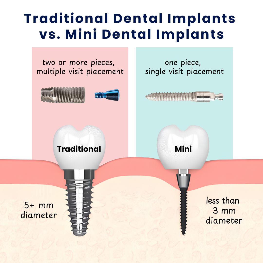 Implante dental mini frente a implante dental convencional