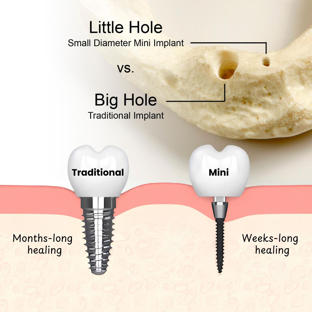 Implante dental mini frente a implante dental convencional