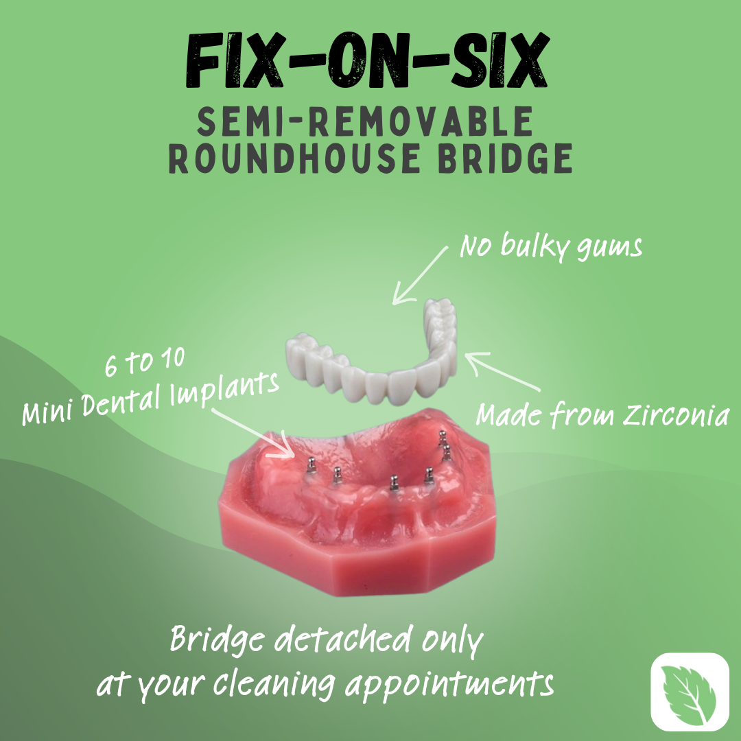 Fix on Six Implant Denture in Pennsylvania