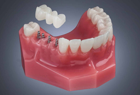 Dental Bridges and Implants in Wilkes-Barre, PA | Call Today!