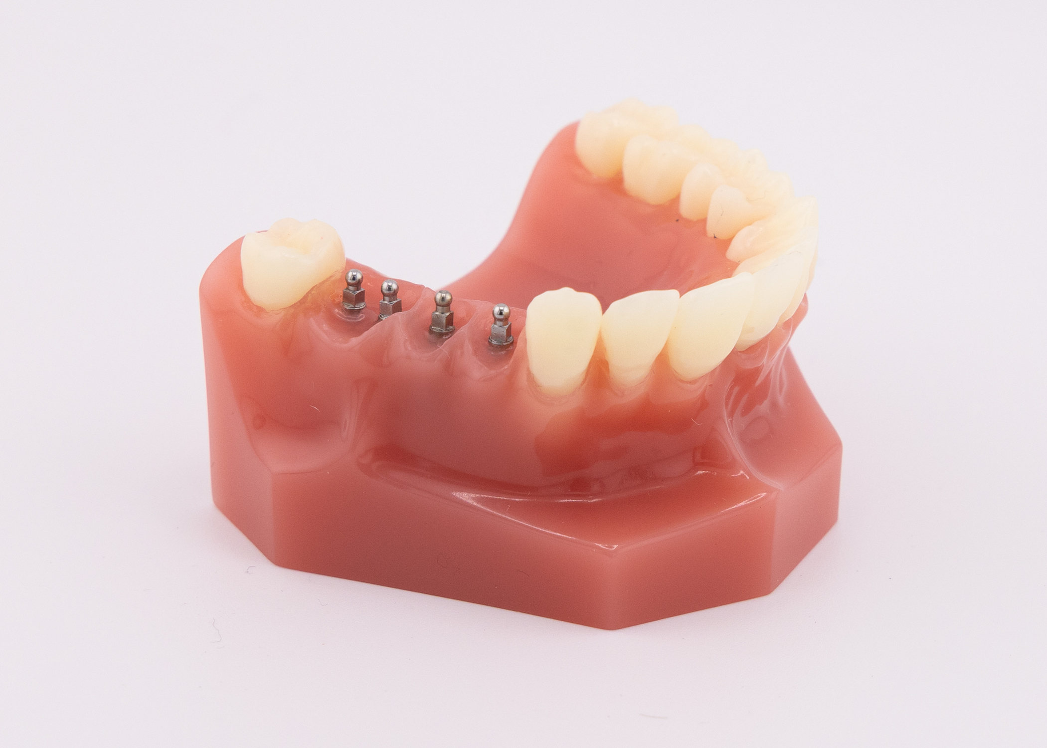 Implant Bridges in Wilkes-Barre, PA | Book a FREE Consultation!